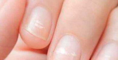 ¿Qué son y por qué aparecen manchas blancas en las uñas?
